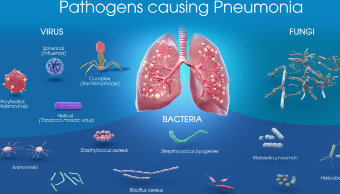 Pneumonia Berkaitan Erat Dengan Penyakit Peradangan Paru