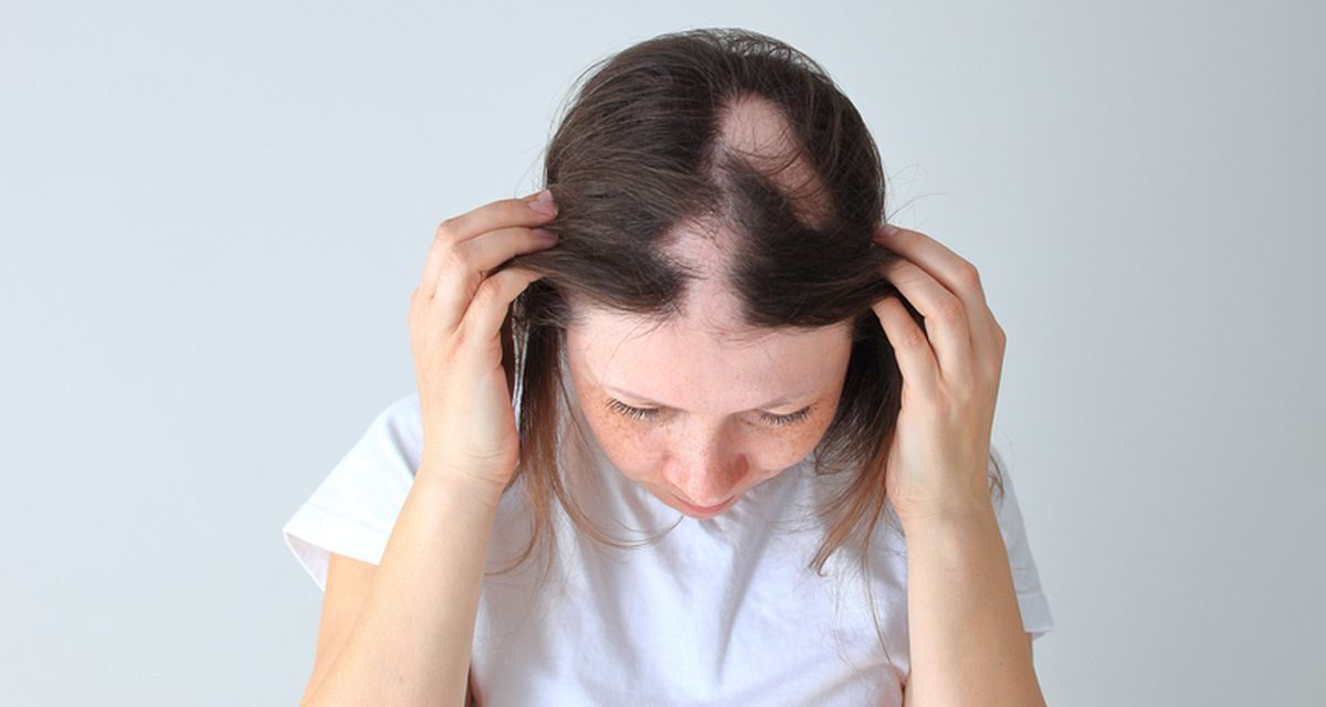 Alopecia Areata, Kenali Risiko Dan Cara Mengatasinya