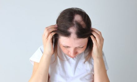 Alopecia Areata, Kenali Risiko Dan Cara Mengatasinya