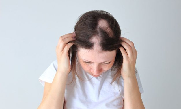 Alopecia Areata, Kenali Risiko Dan Cara Mengatasinya