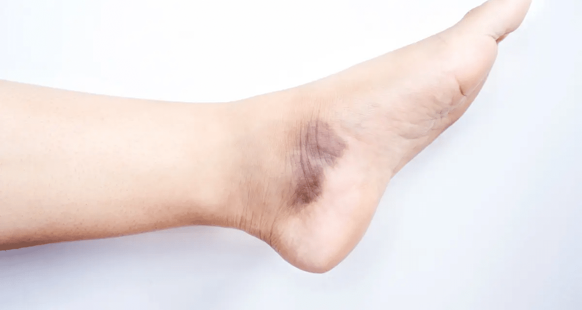 Penyakit Vaskulitis, Peradangan Pembuluh Darah Perlu Waspada