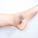 Penyakit Vaskulitis, Peradangan Pembuluh Darah Perlu Waspada