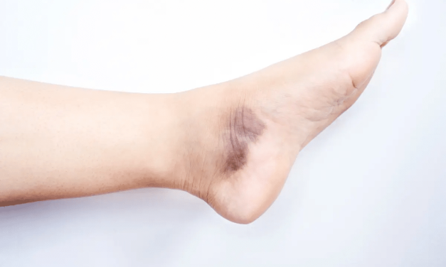 Penyakit Vaskulitis, Peradangan Pembuluh Darah Perlu Waspada